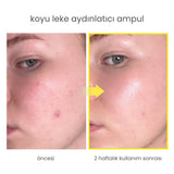 Niacindy Dark Spot Leke Karşıtı & Cilt Tonu Eşitleyen Aydınlatıcı Ampul - 15 mL
