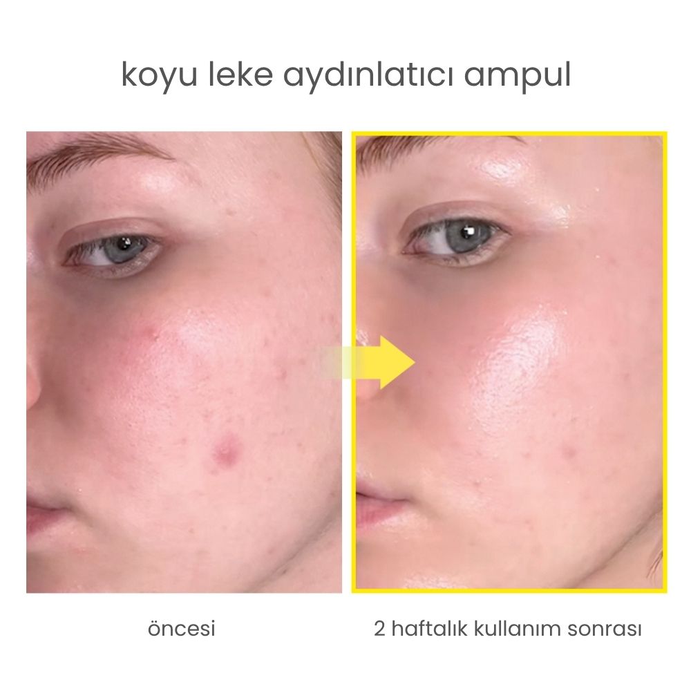 Niacindy Dark Spot Leke Karşıtı & Cilt Tonu Eşitleyen Aydınlatıcı Ampul - 15 mL