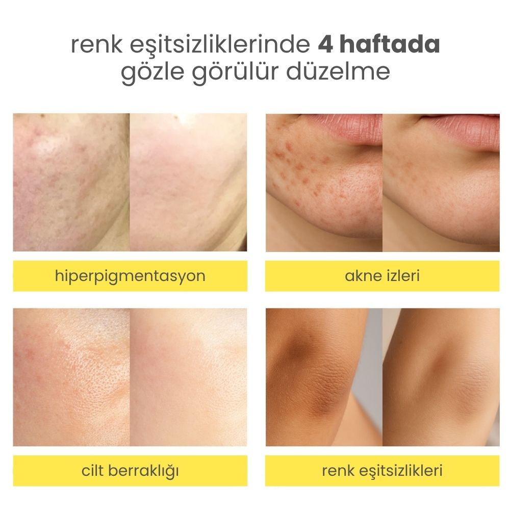 Niacindy Dark Spot Leke Karşıtı & Cilt Tonu Eşitleyen Aydınlatıcı Ampul - 15 mL