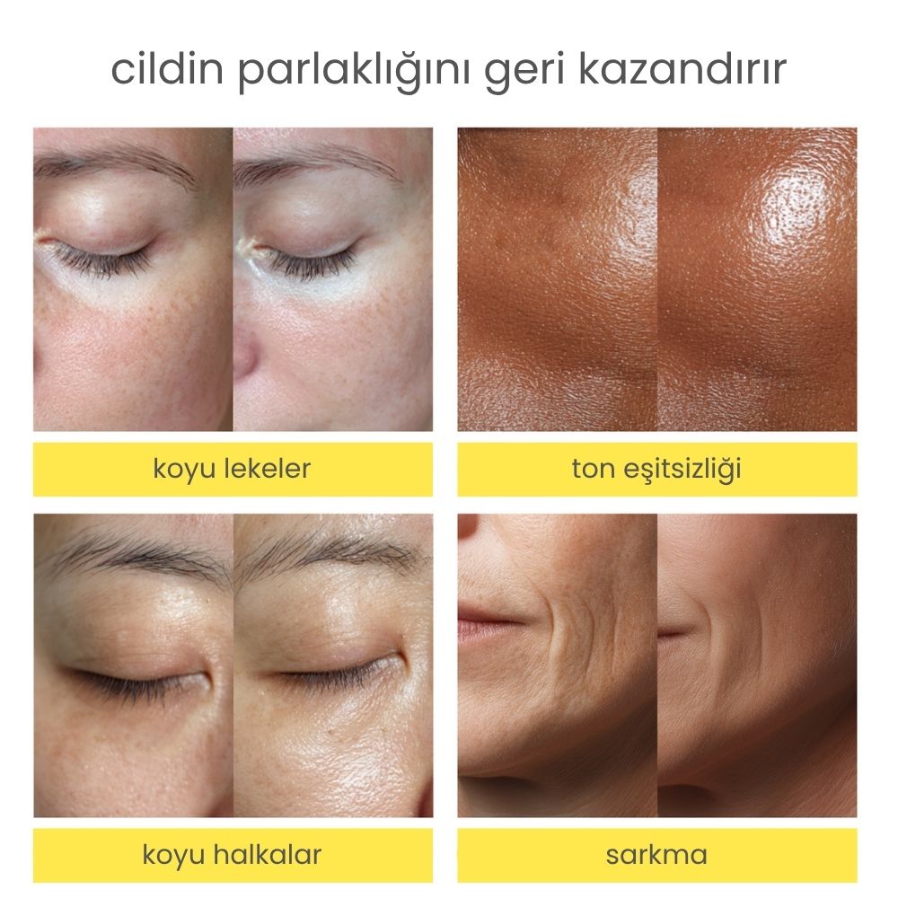 Niacindy Dark Spot Leke Karşıtı & Cilt Tonu Eşitleyen Aydınlatıcı Ampul - 15 mL