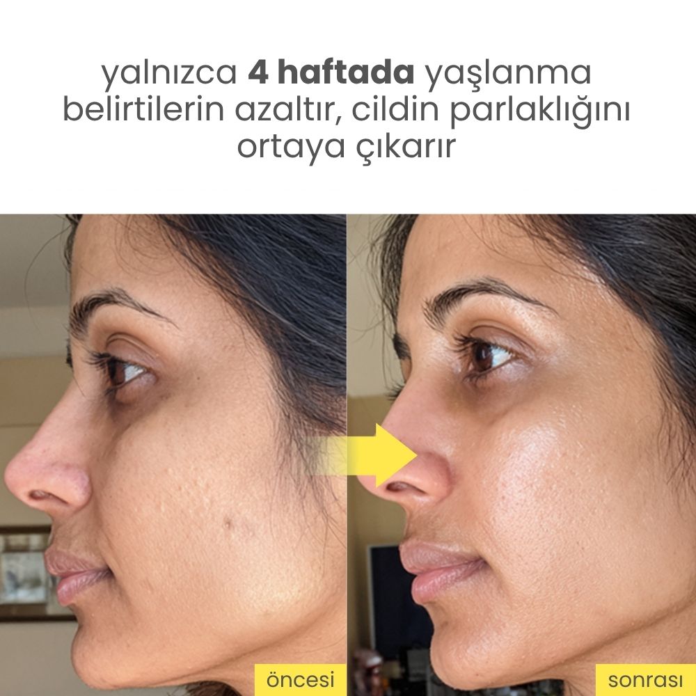 Niacindy Dark Spot Leke Karşıtı & Cilt Tonu Eşitleyen Aydınlatıcı Ampul - 15 mL